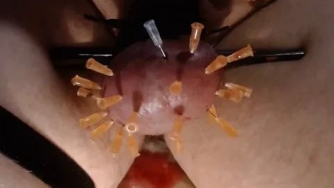 Some Needles in Balls With Bloody Consequences