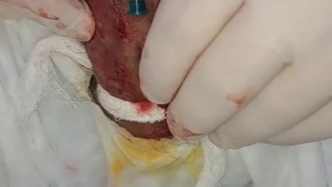 Two needles through my penis head