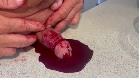Needles removed from cock head | PenisCrush.com